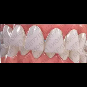 Зубная форма для выравнивания зубов Invisalign