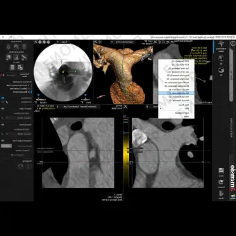 Анатомическое программное обеспечение 3mensio Pulmonary valve