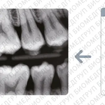 Vatech EzSensor Стоматологический радиовизиограф