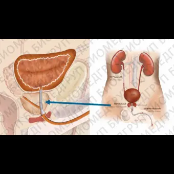 Простатический стент Memokath028