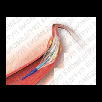 Катетер PTCA POWERLINE