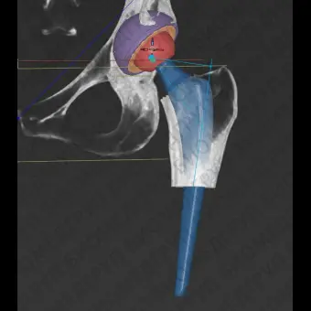 Программное обеспечение TDM mediCAD 3D Hip