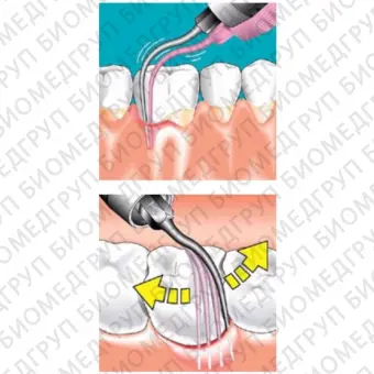 Sonicflex paro 60  длинная прямая насадка с закругленной верхушкой для минимально инвазивной терапии пародонтита