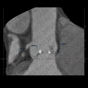 Медицинское программное обеспечение 3mensio Aortic valve