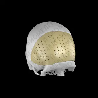 Черепной имплантат на заказ Recranio