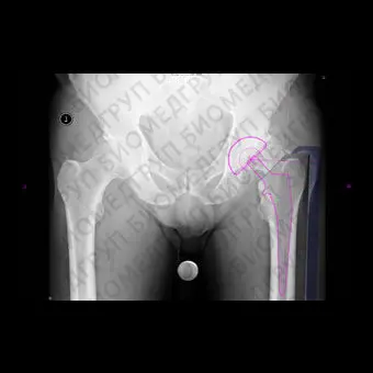 Программное обеспечение для хирургии тазобедренного сустава Hip Arthroplasty