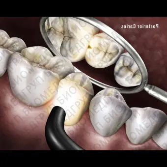 Детектор кариеса диафаноскопией Microlux 2 Diagnostic System PN 1100803