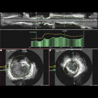 Программное обеспечение для исследования сосудов CAAS IVUS OCT