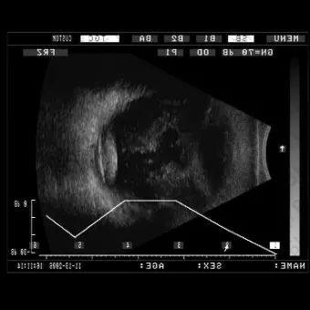 Офтальмологический эхограф ODM2200