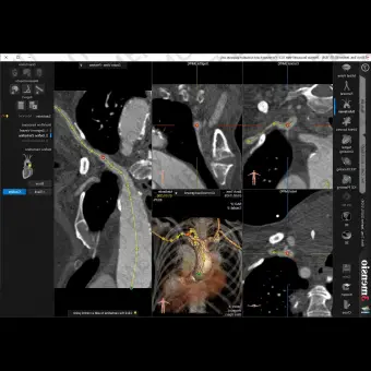 Медицинское программное обеспечение 3mensio Aortic valve