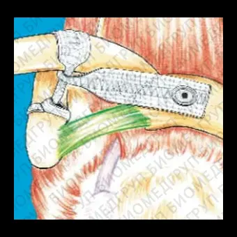 Лигаментарный протез акромиальноключичное сочленение ACROLIG