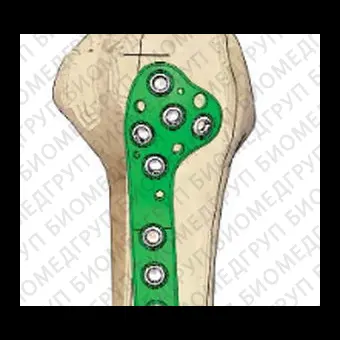 Компрессионная костная пластина плечевая кость P.R.C.T II