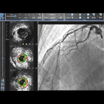 Программное обеспечение для исследования сосудов CAAS IVUS OCT