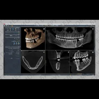 Программное обеспечение для обработки снимков зубов SIDEXIS 4