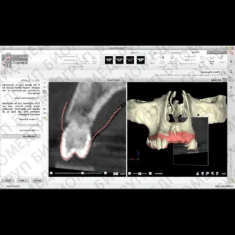 Программное обеспечение для стоматологической имплантологии NobelClinician