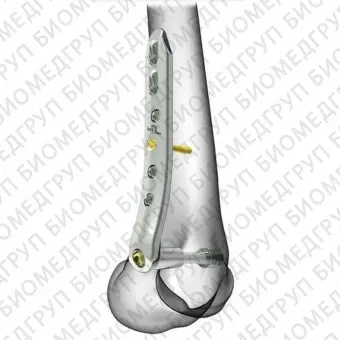 Компрессионная костная пластина для мыщелка бедренной кости DCS