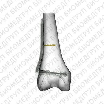 Компрессионная костная пластина для мыщелка бедренной кости DCS