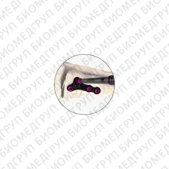 Костная пластина для остеотомии искривление большого пальца стопы наружу airlock
