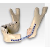 Костная пластина для остеотомии для нижней челюсти CARCITEK